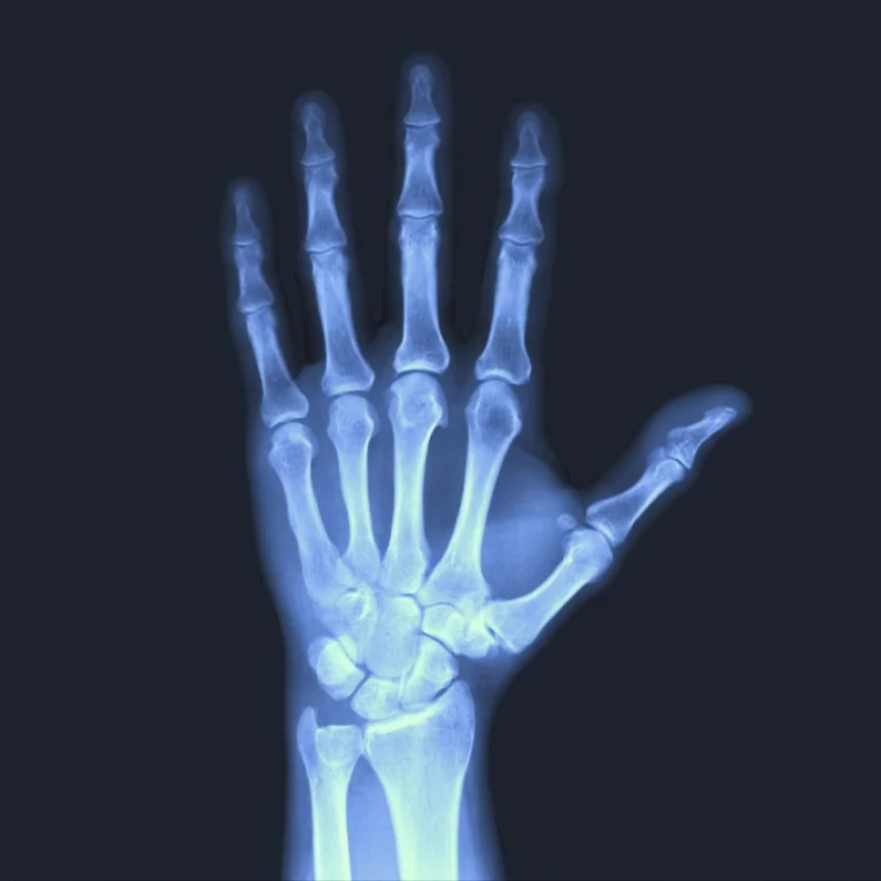 Breuk vinger of hand