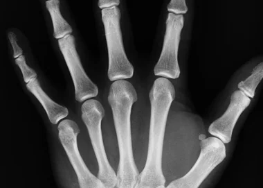Breuk aan de vinger of hand