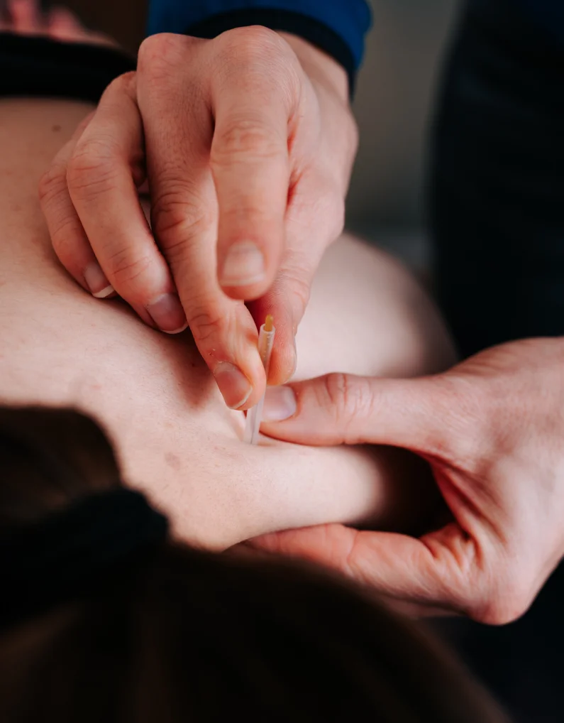 Dry Needling fysiotherapie