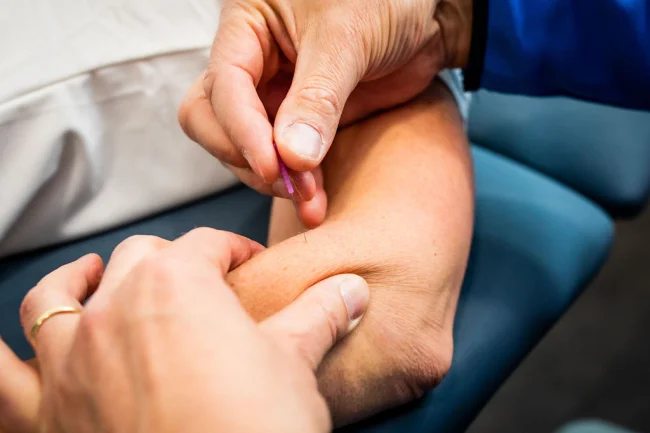 Dry Needling Asten