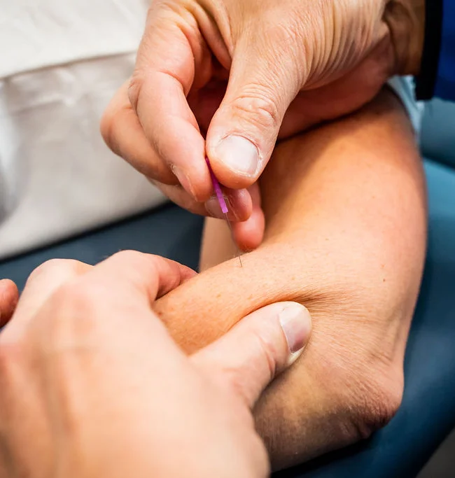 Dry Needling of Acupunctuur