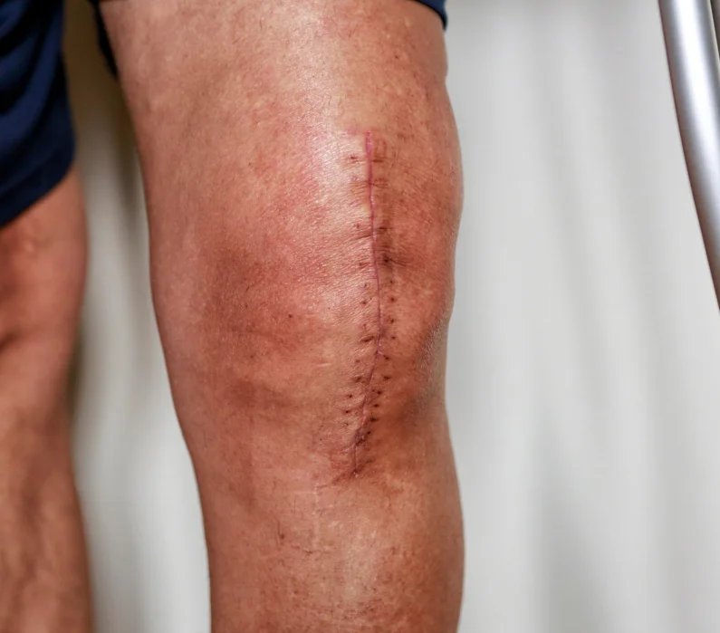 Revalidatie na een nieuwe heup of nieuwe knie